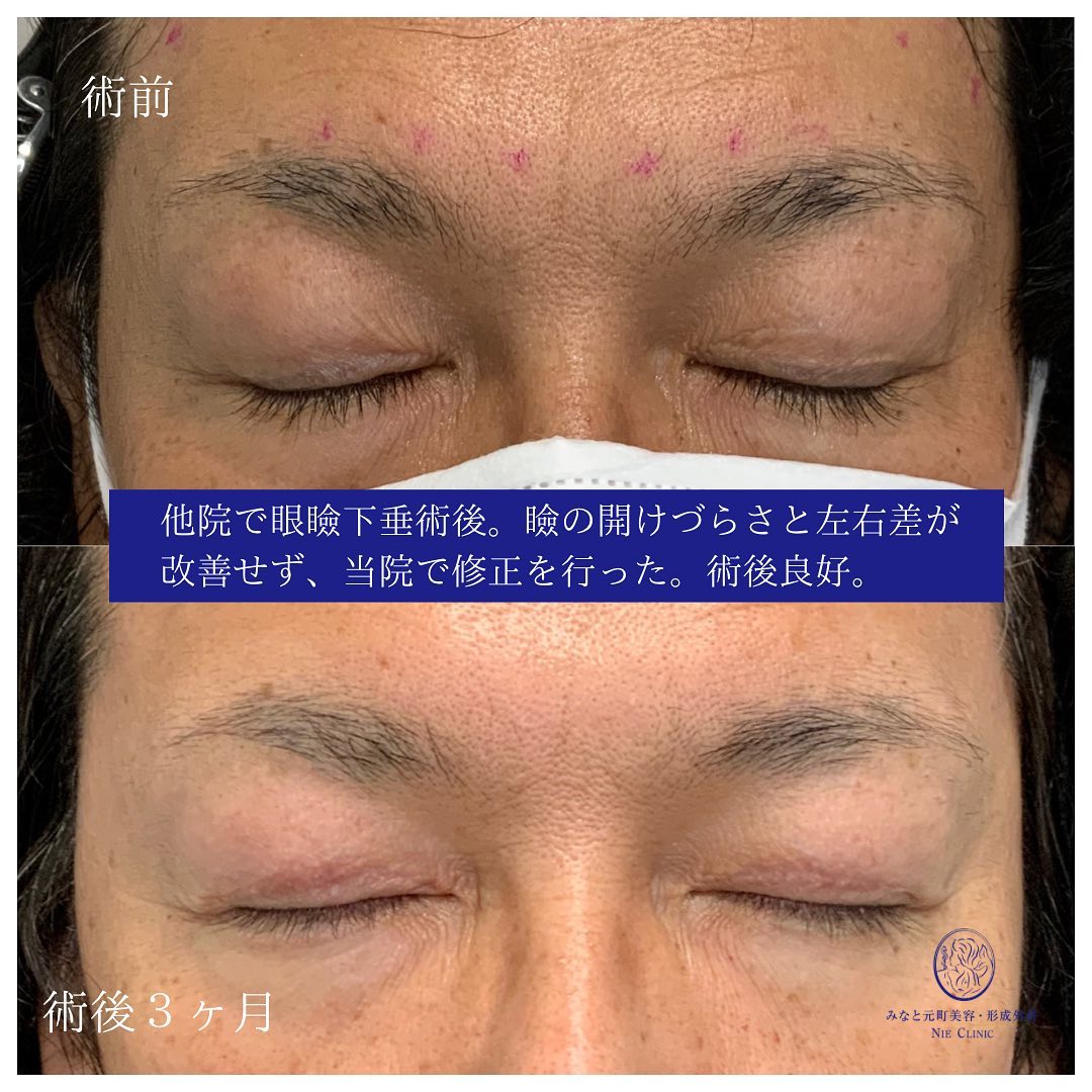 眼瞼下垂の修正