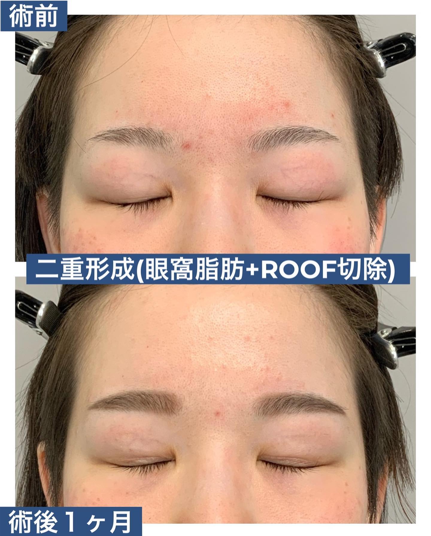 二重形成・切開法(眼窩脂肪+ROOF切除)