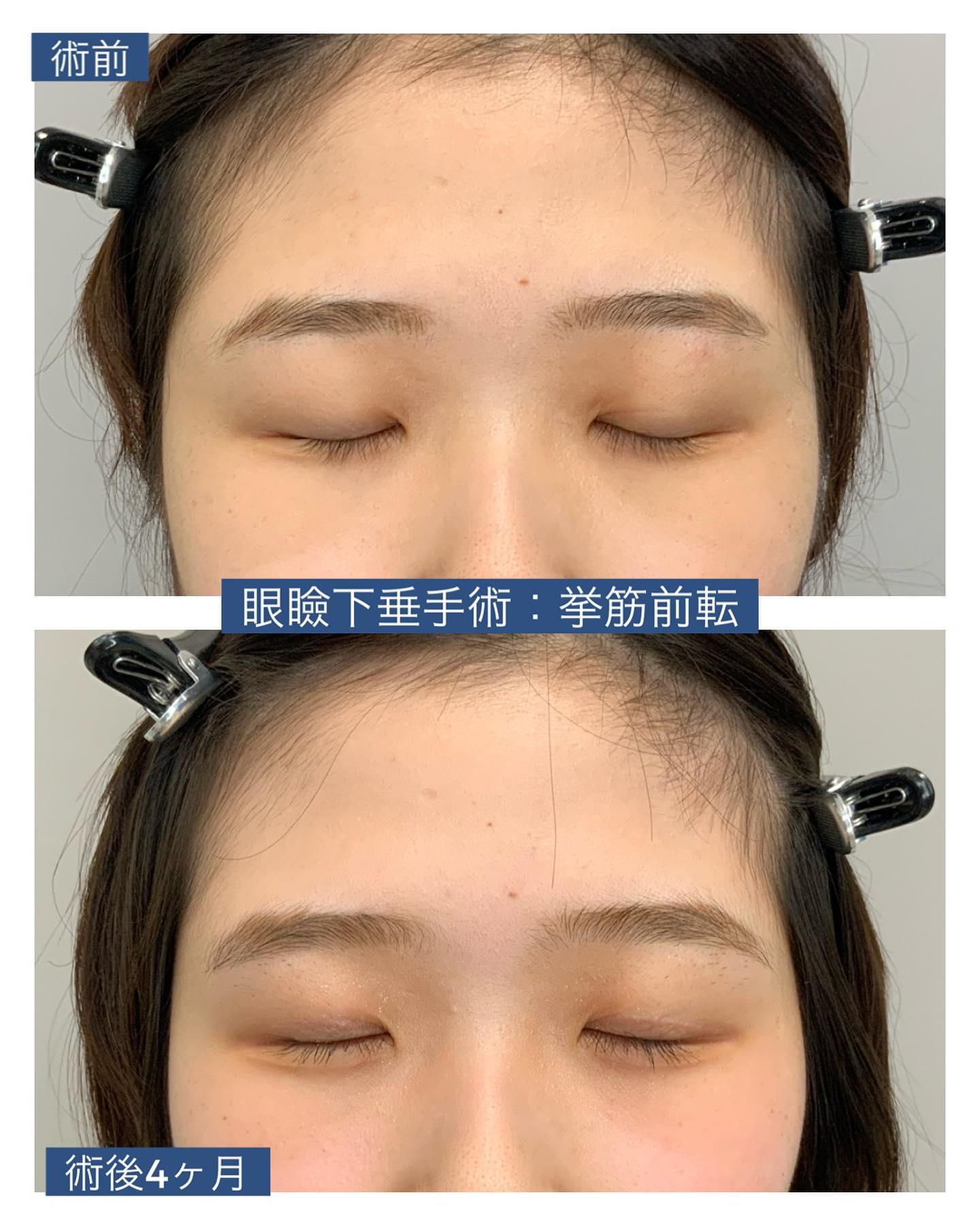 眼瞼下垂症手術:挙筋前転