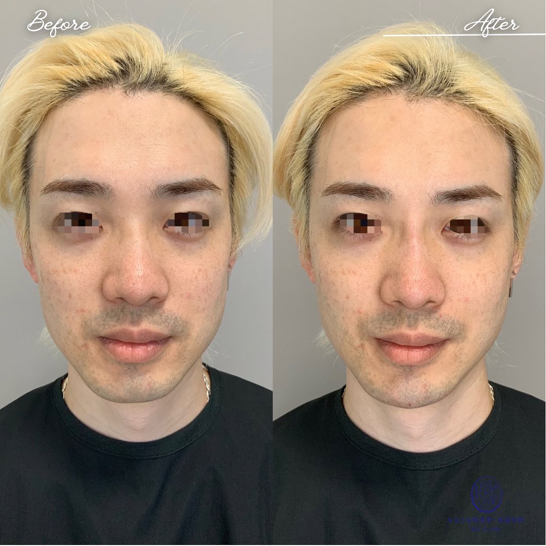 《ヒアルロン酸1cc》