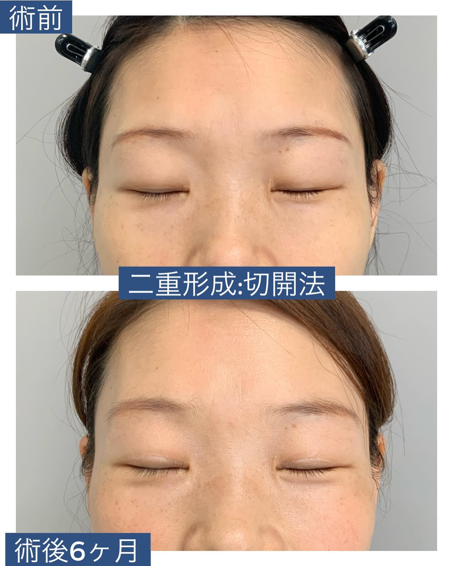 二重形成・切開法(眼窩脂肪+ROOF切除)