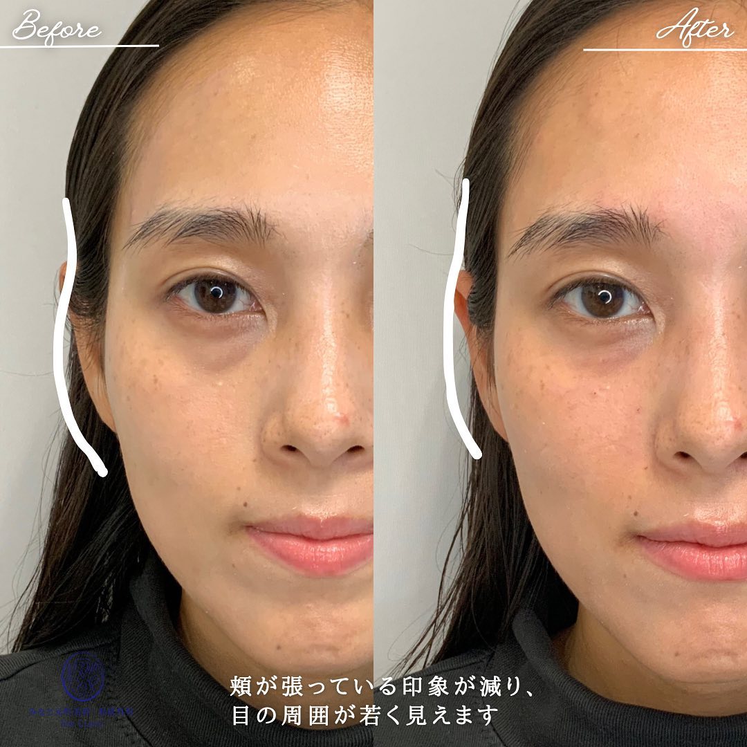 《凹凸感を減らす》