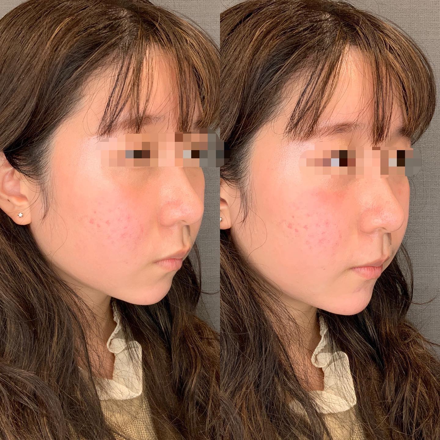 《ヒアルロン酸1cc✨》