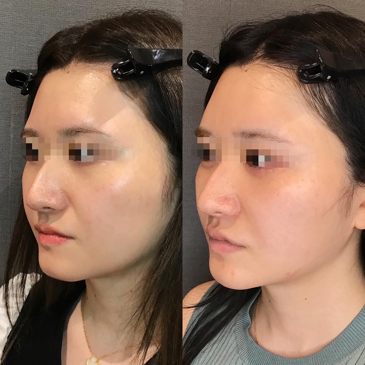 《ヒアルロン酸8cc✨》