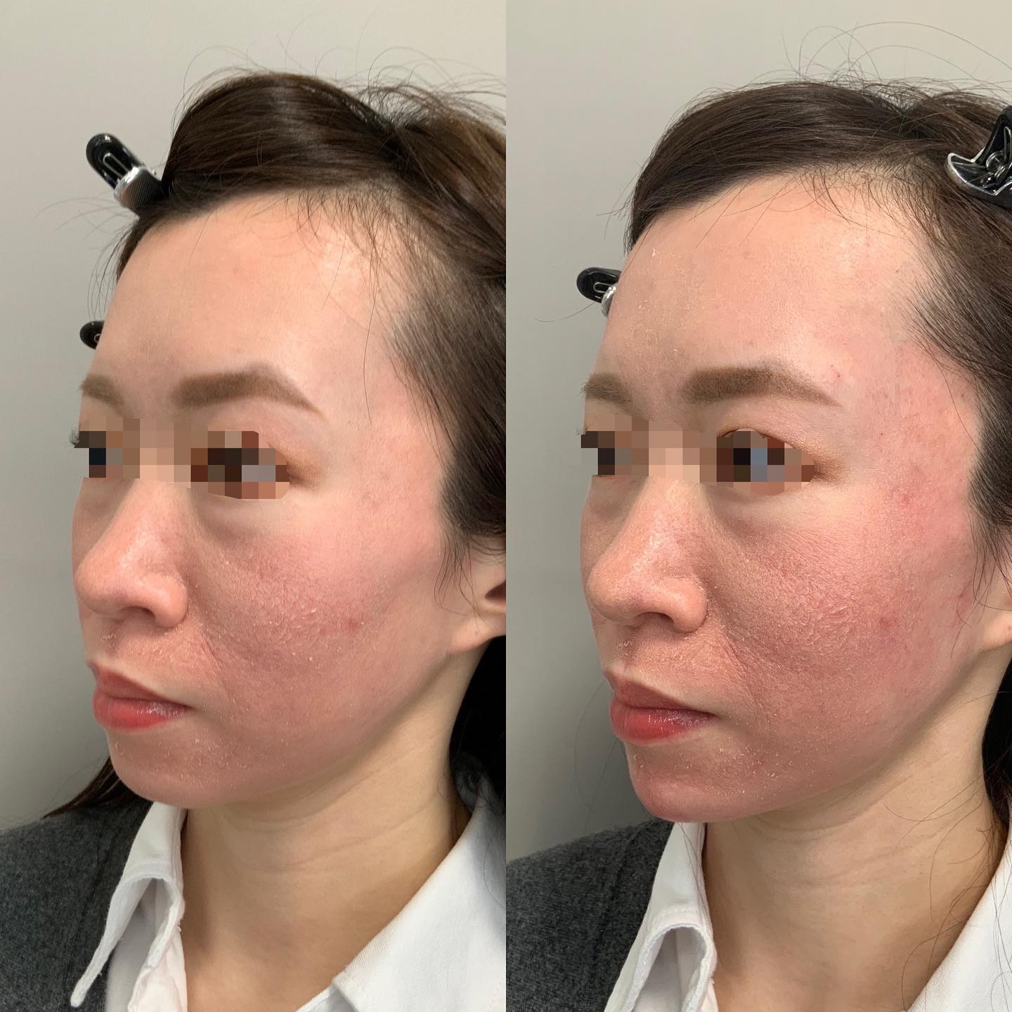 《ヒアルロン酸3.5cc✨》