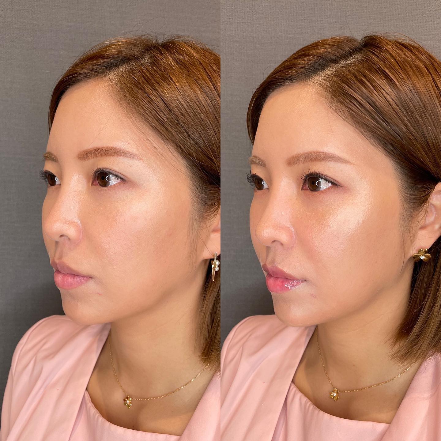 《ヒアルロン酸1.4cc》