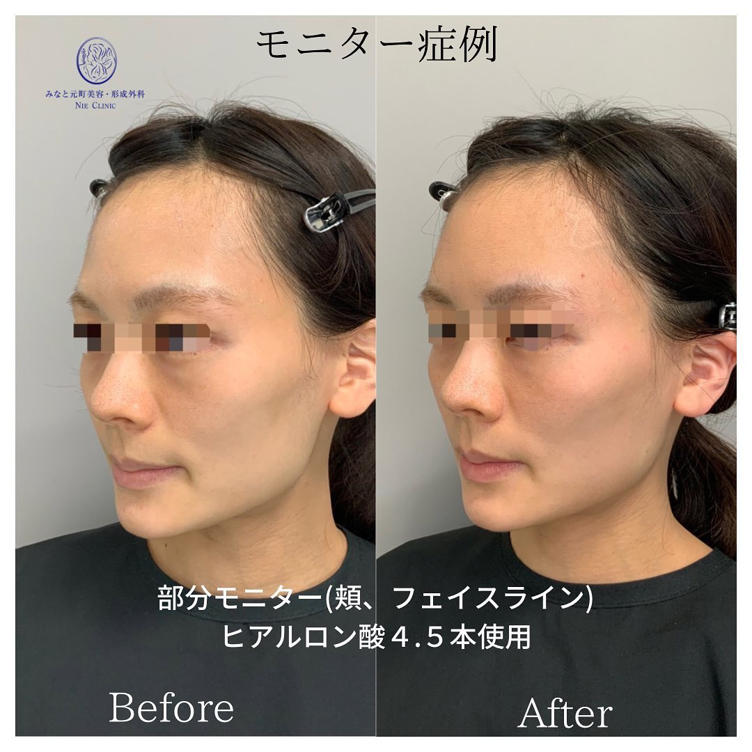 《ヒアルロン酸4.5cc》
