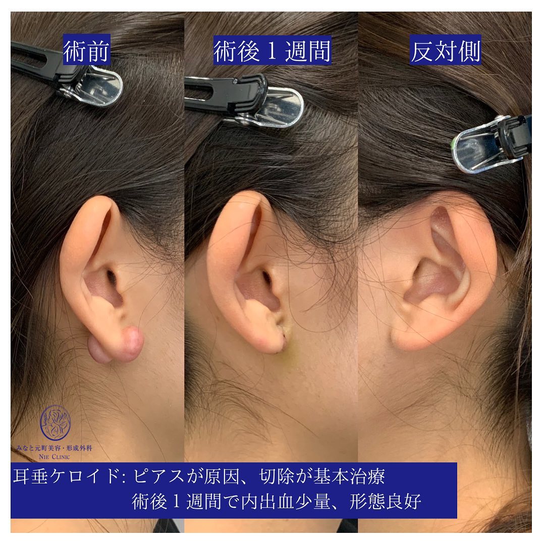 耳垂ケロイド
