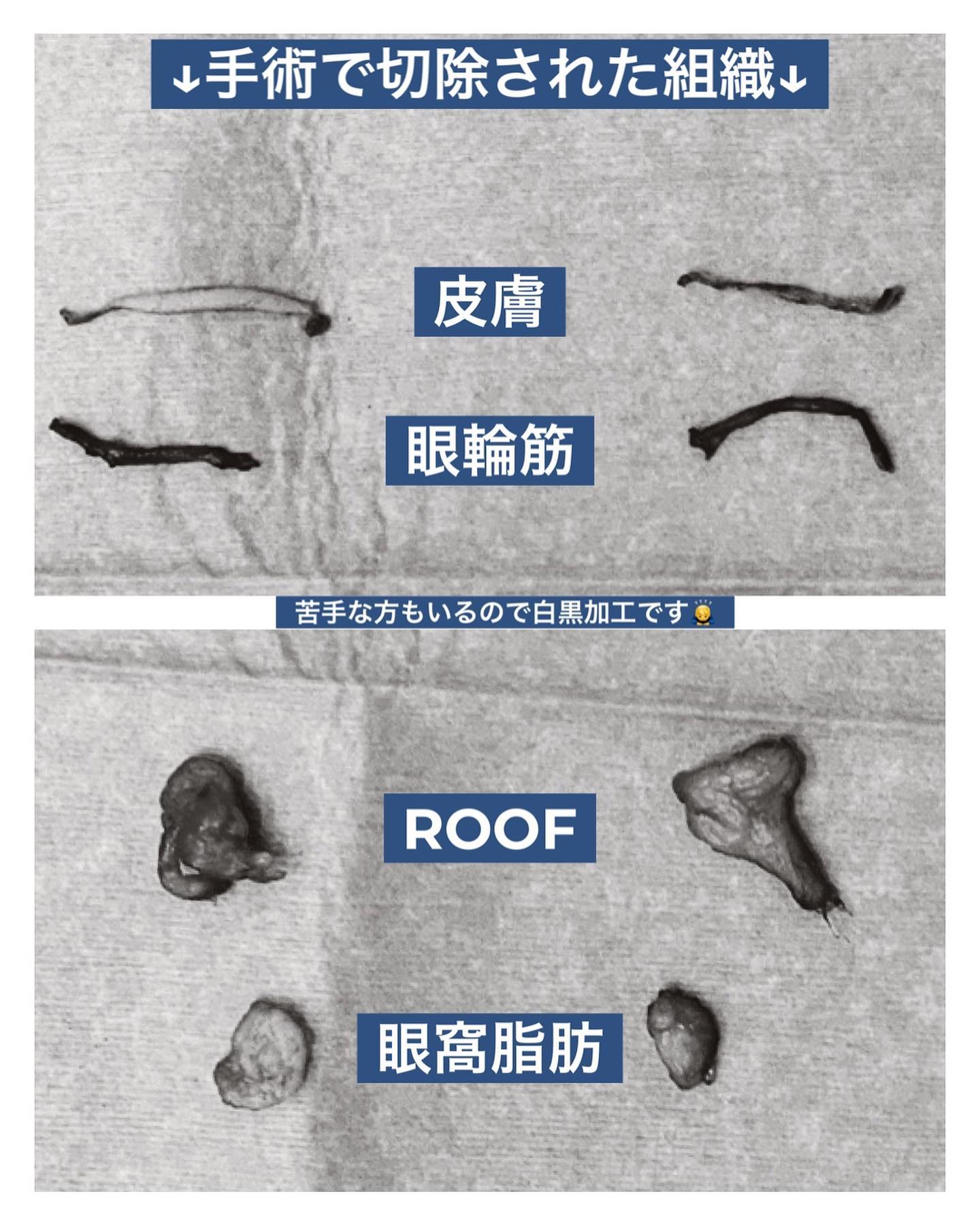 二重形成・切開法(眼窩脂肪+ROOF切除)