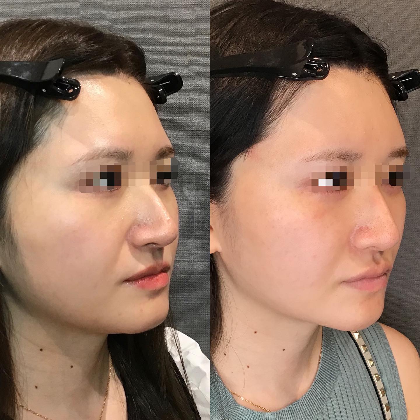 《ヒアルロン酸8cc✨》