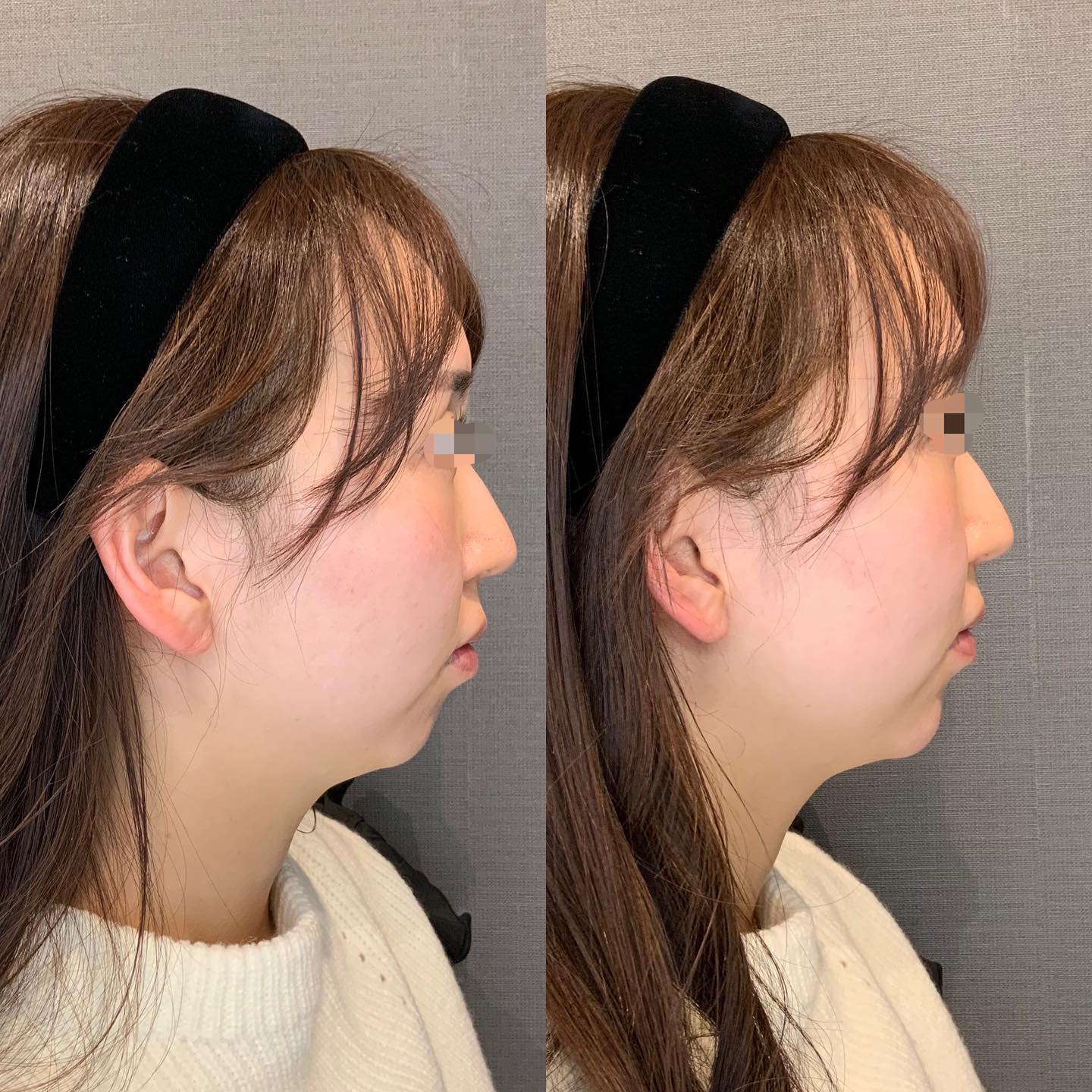 《ヒアルロン酸1cc✨》