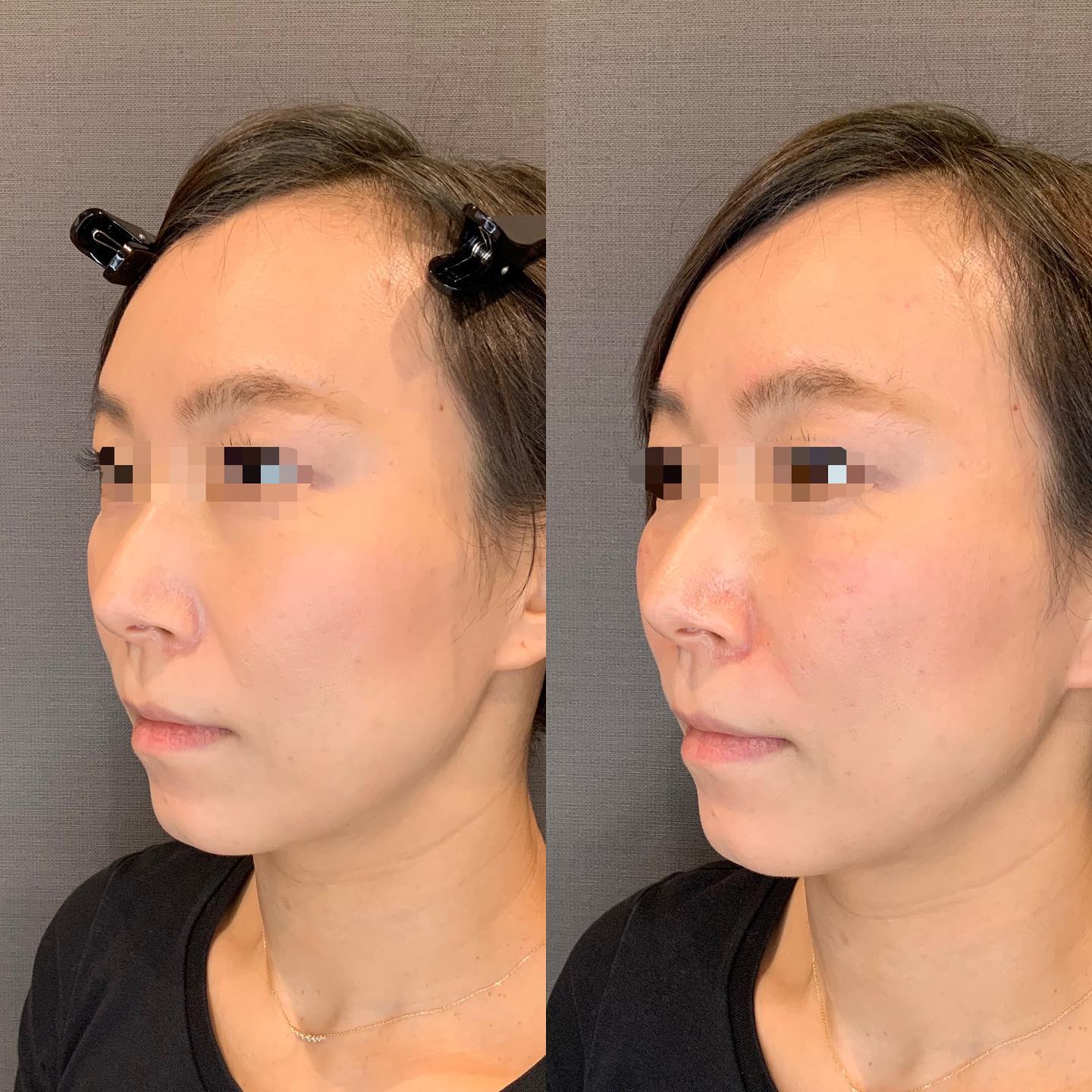 《ヒアルロン酸2cc✨》