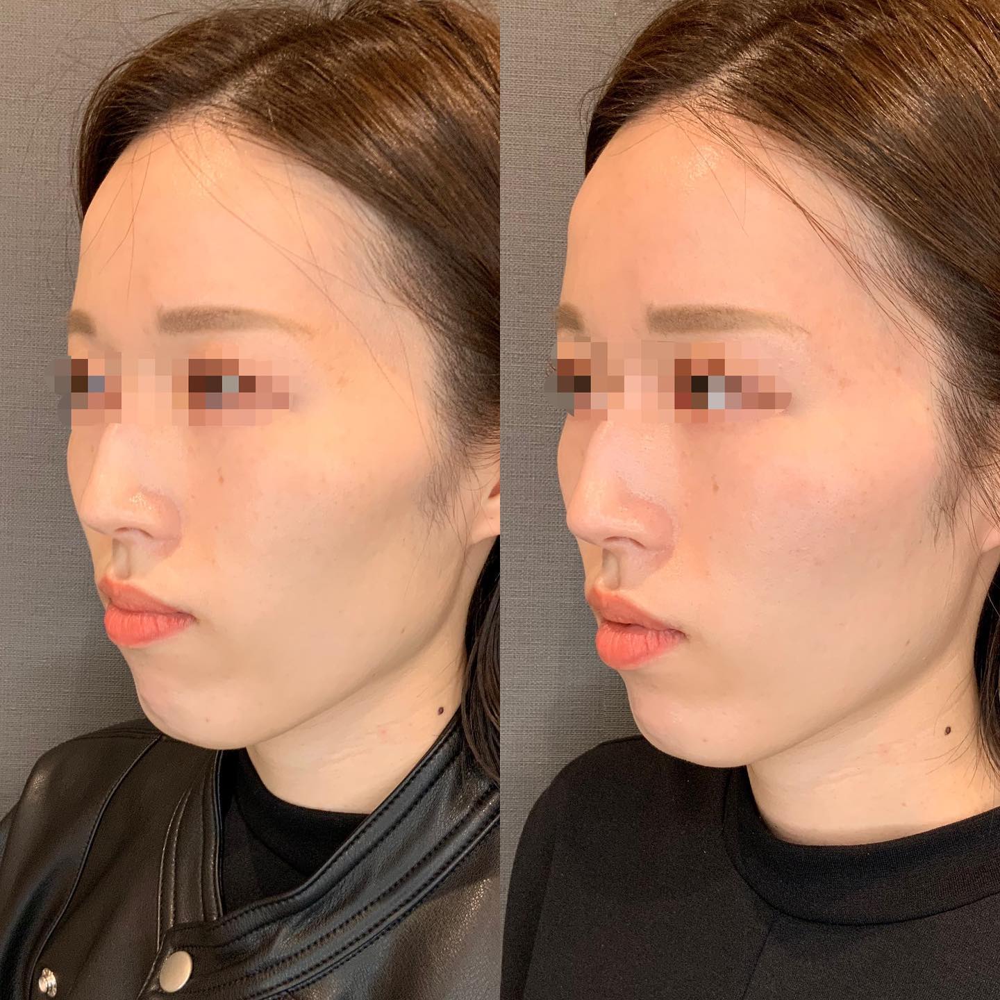 《ヒアルロン酸3cc✨》