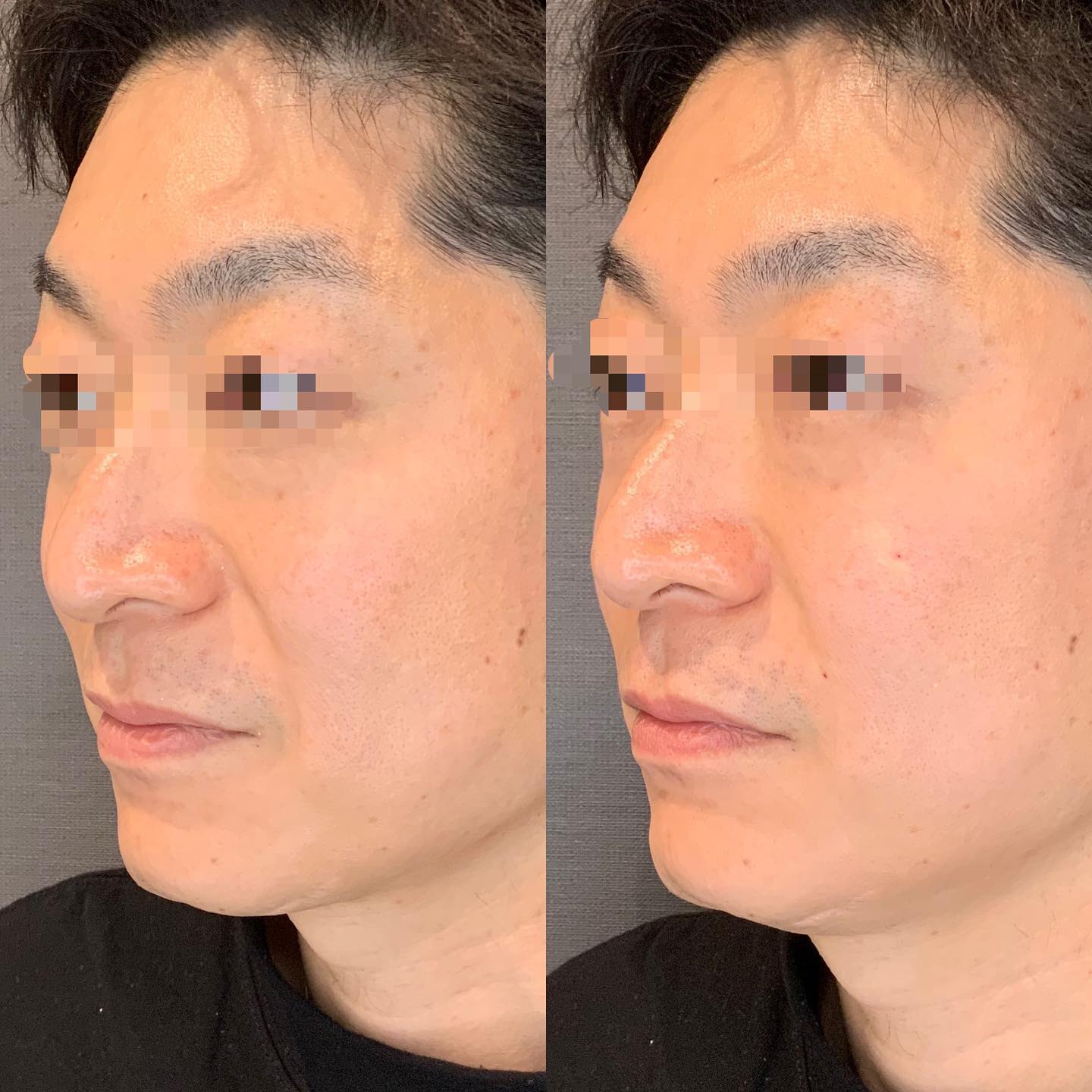 《ヒアルロン酸3cc✨》