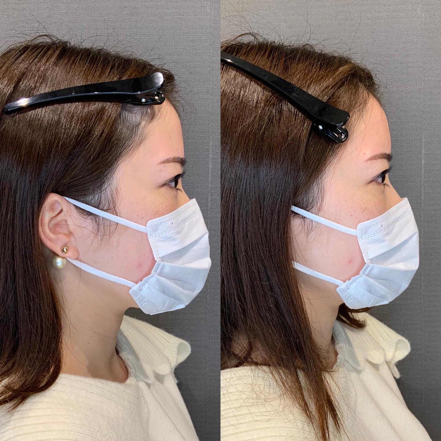 《ヒアルロン酸1.5cc✨》