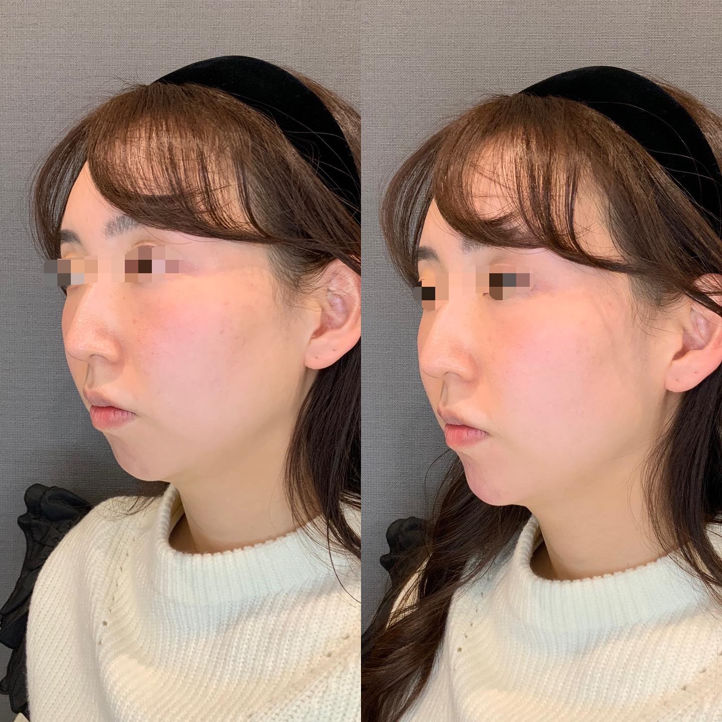 《ヒアルロン酸1cc✨》