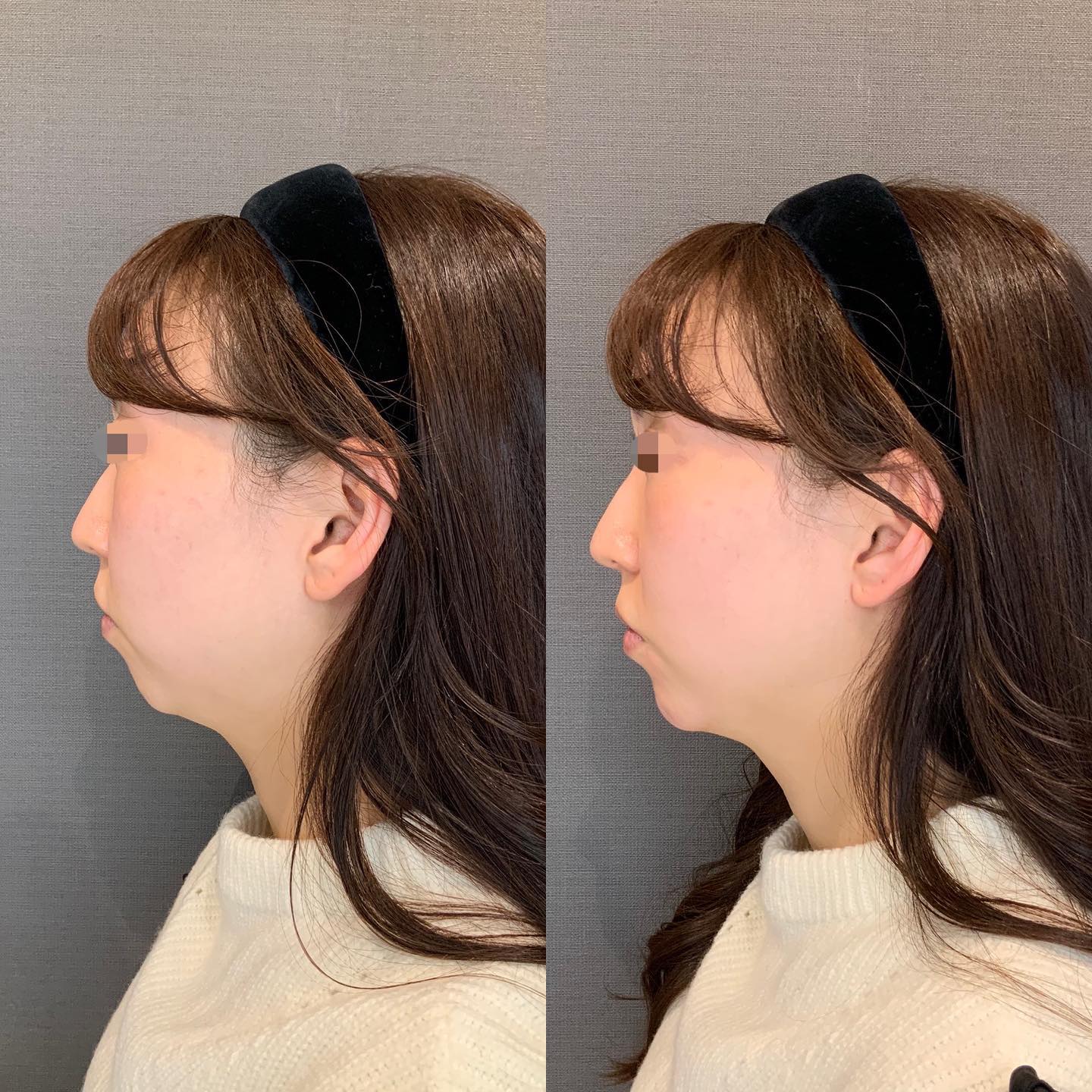 《ヒアルロン酸1cc✨》