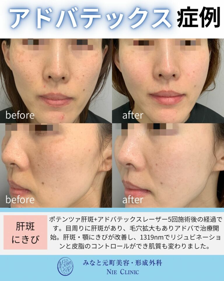 肝斑・ニキビ・毛穴へポテンツァとアドバテックスを併用した症例の関連記事サムネイル