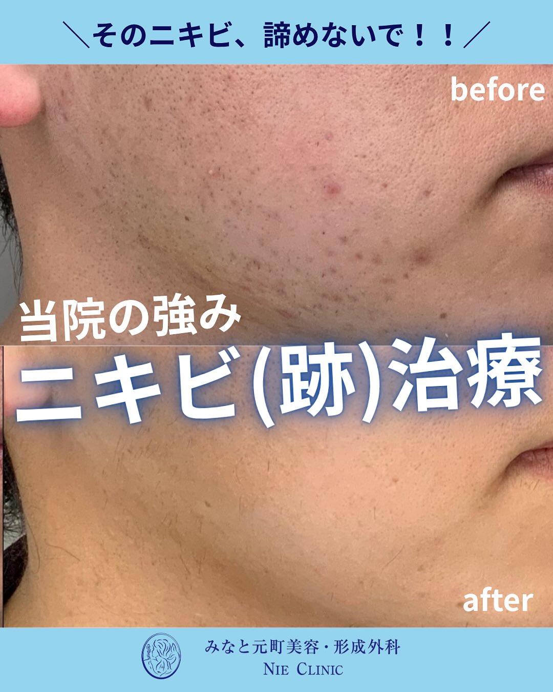 《ニキビ・ニキビ跡治療》についてまとめました