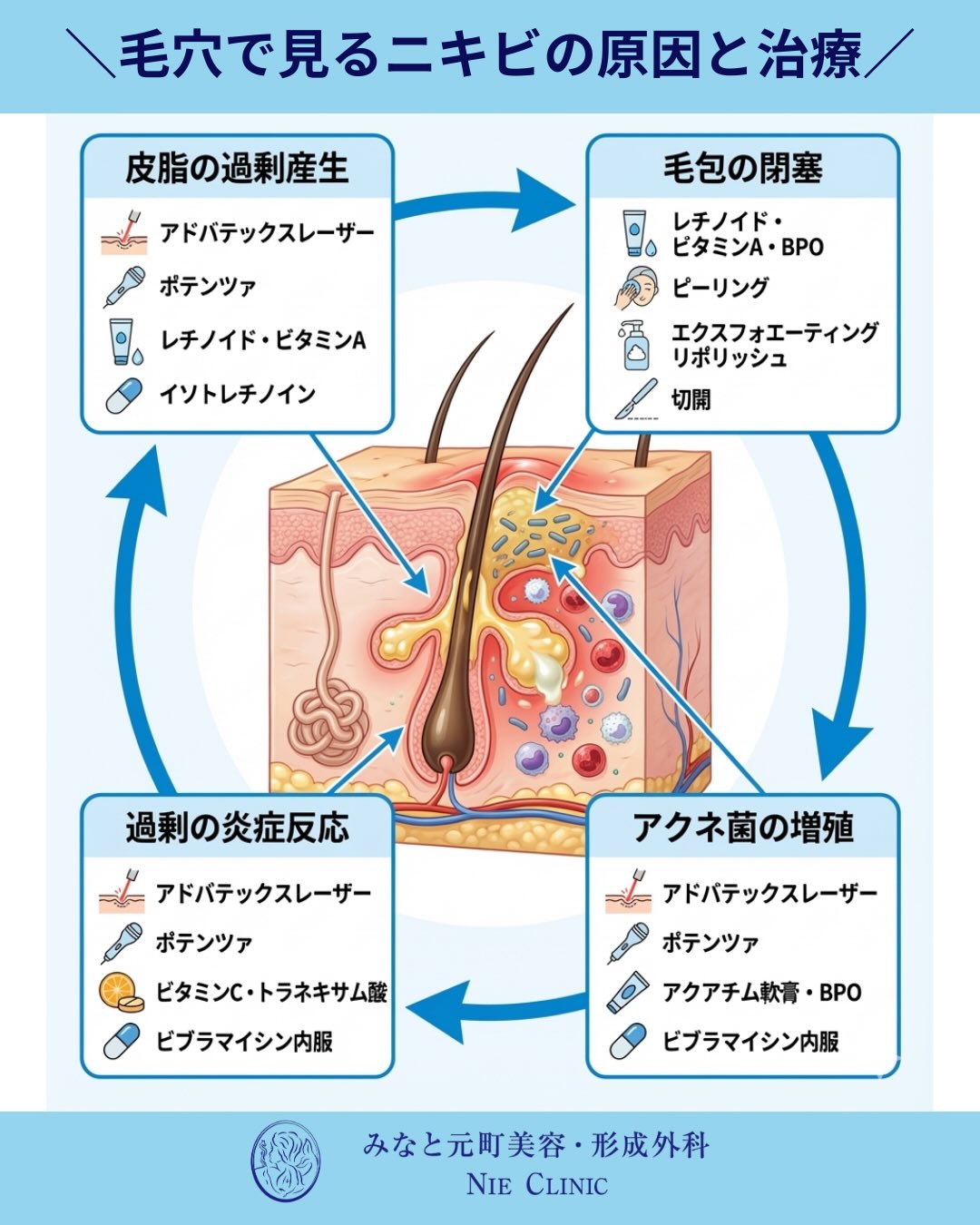 大人ニキビの複雑な要因と、適切な治療およびスキンケアのアプローチについて解説します🩺