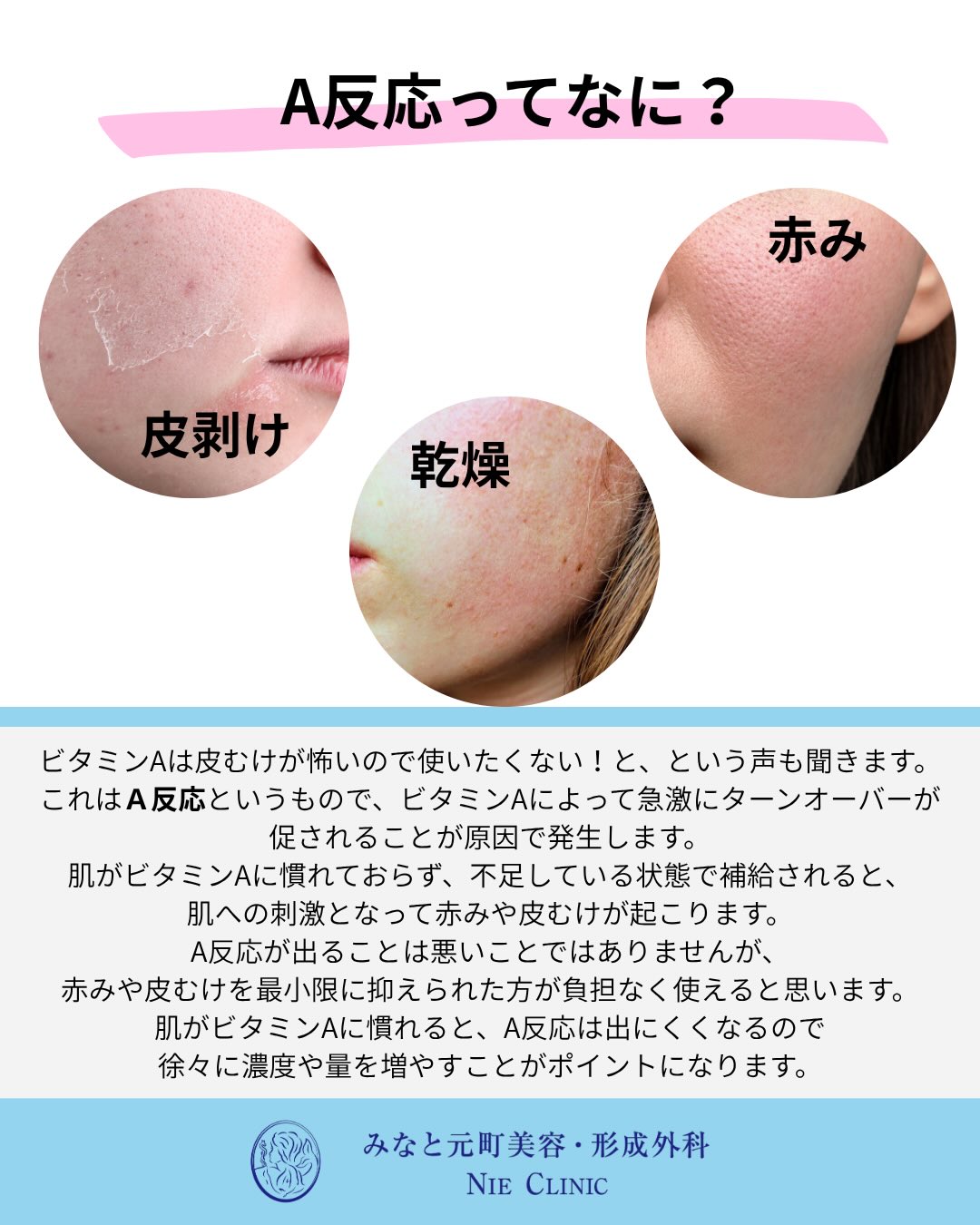 ビタミンAは、肌のターンオーバーを整え、毛穴の詰まりやニキビ、色むらを改善するだけでなく、真皮のコラーゲンやヒアルロン酸を増やしてハリや小じわもケアできる素晴らしい成分です✨