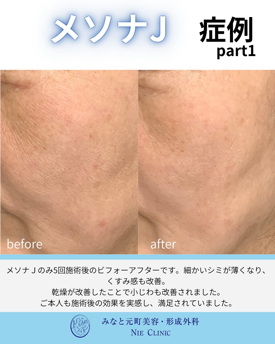 メソナJのご紹介
