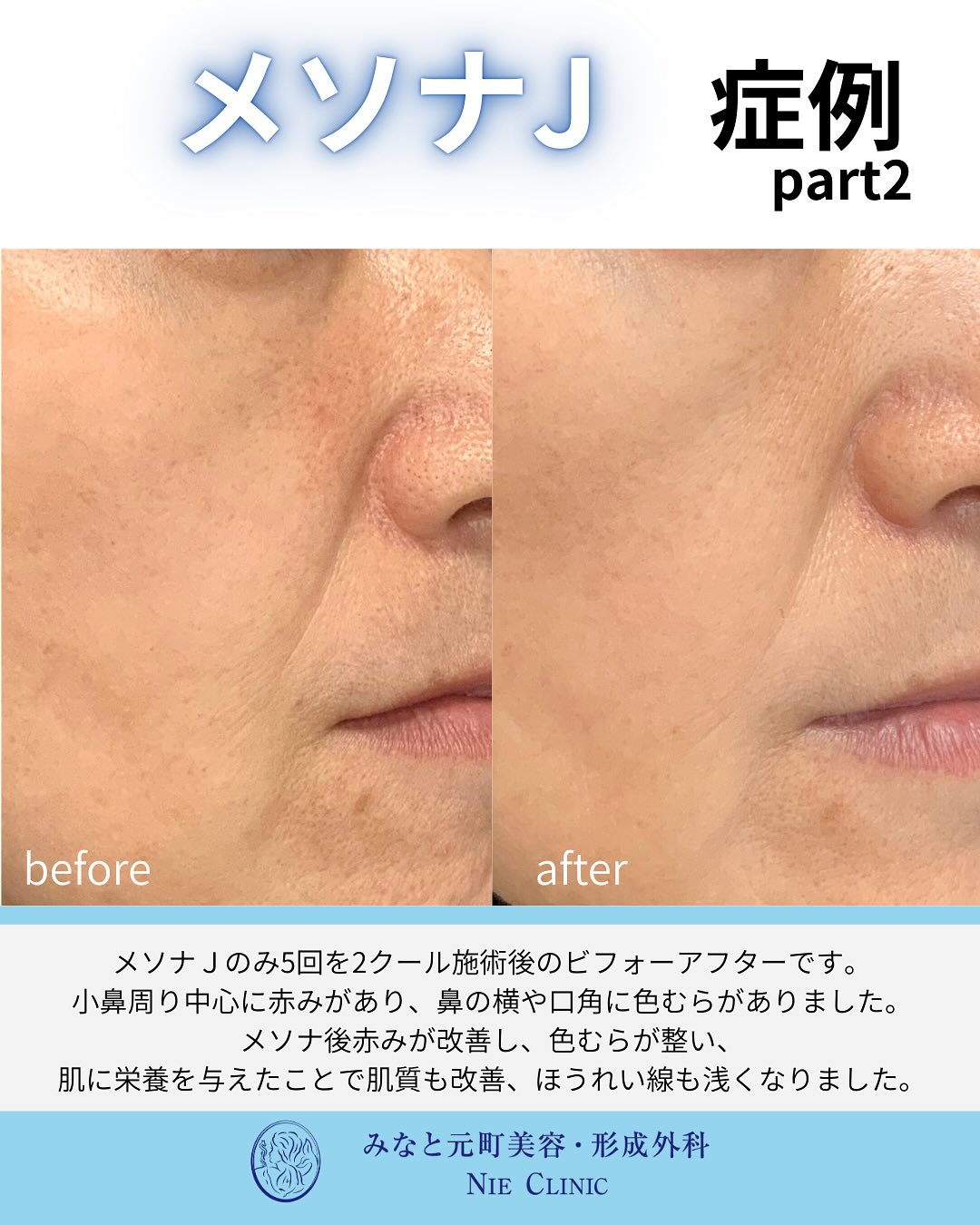 メソナJのご紹介