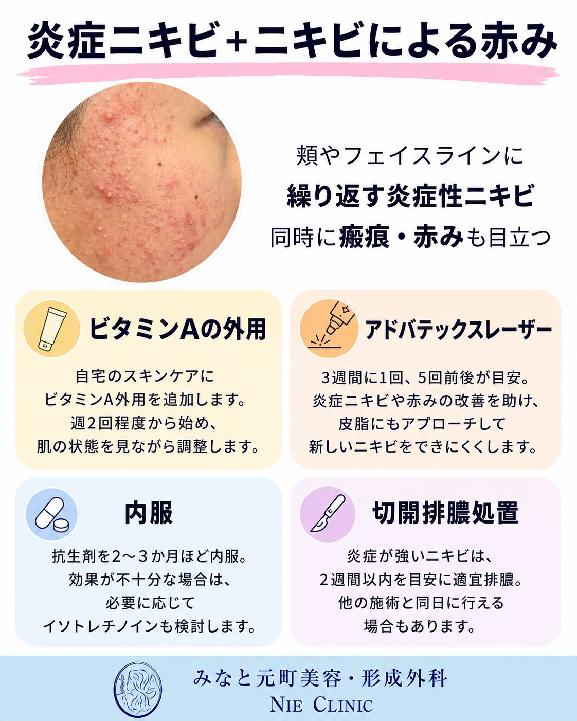 《ニキビ・ニキビ跡治療》についてまとめました