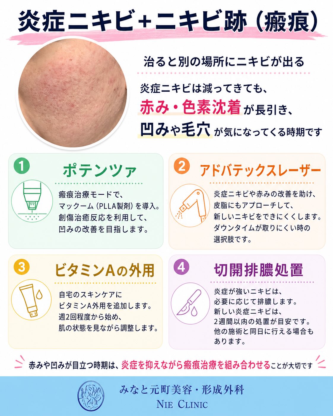 《ニキビ・ニキビ跡治療》についてまとめました