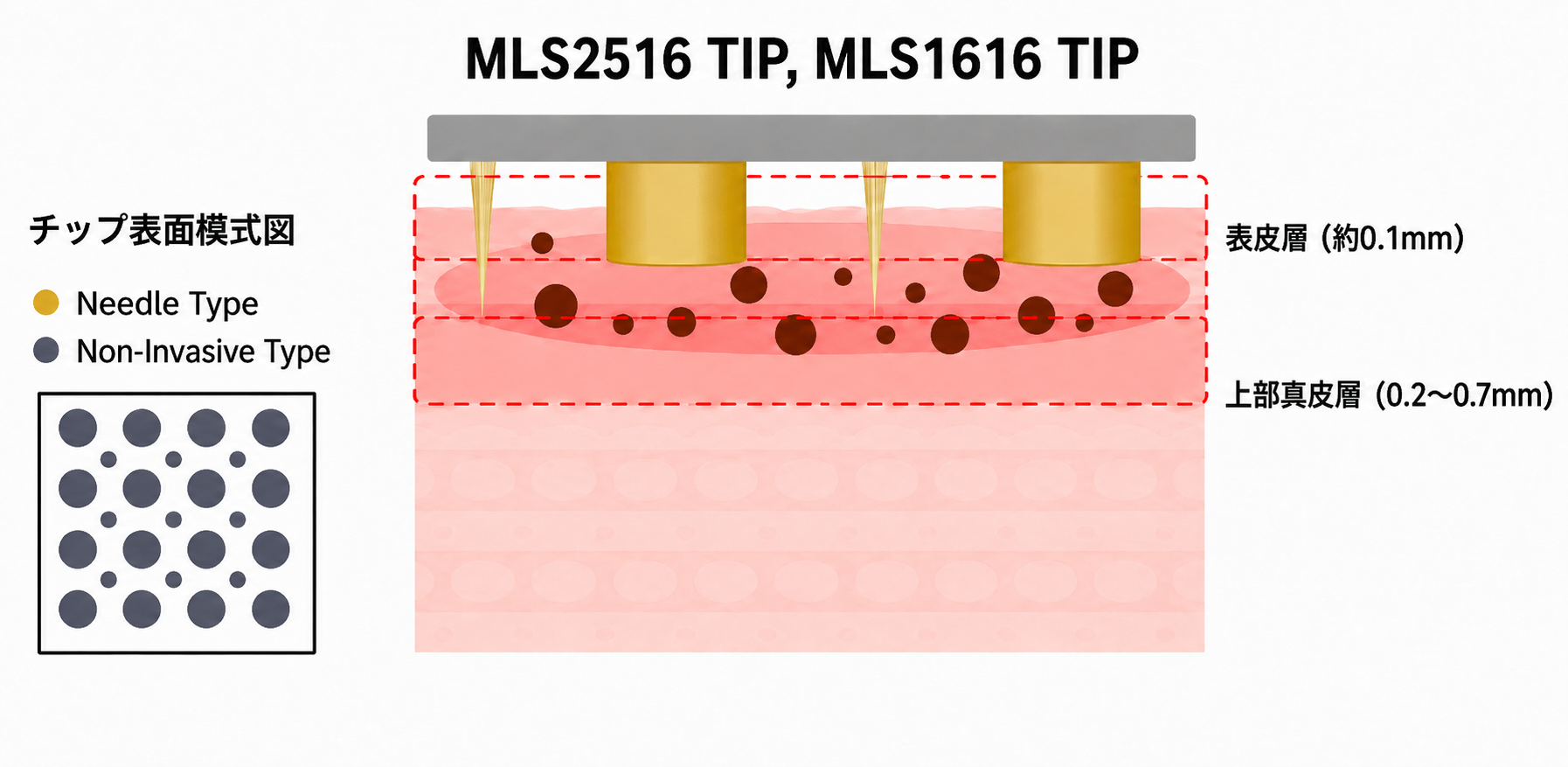 MLS2516 TIPとMLS1616 TIPの表皮層・上部真皮層への作用模式図