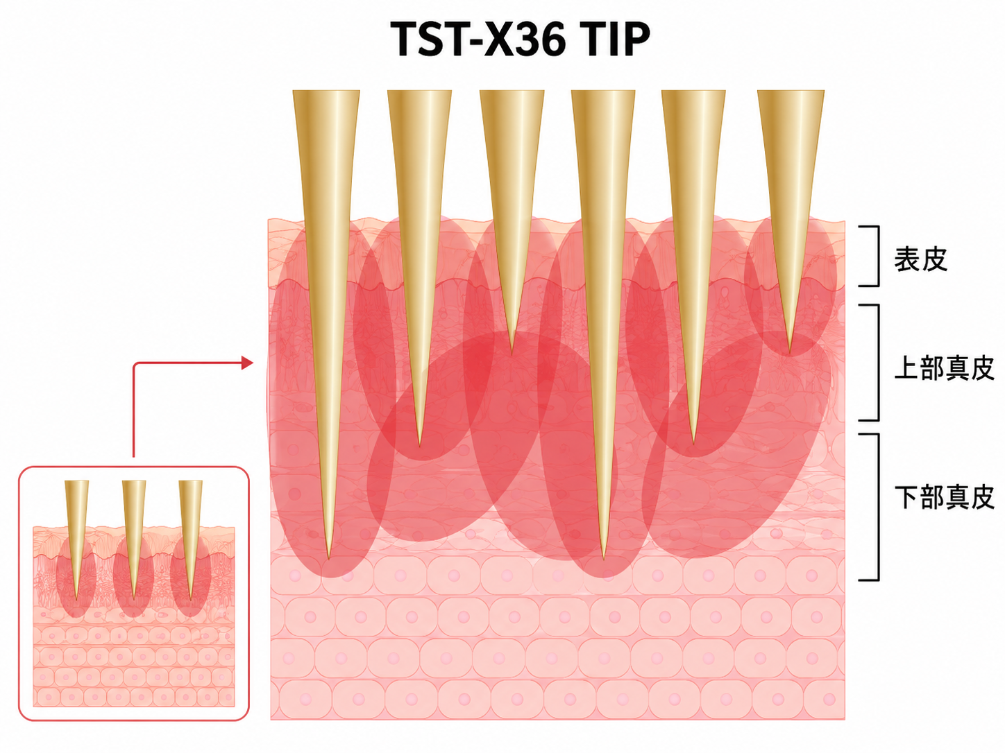 TST-X36 TIPの複数深度へのRF照射イメージ