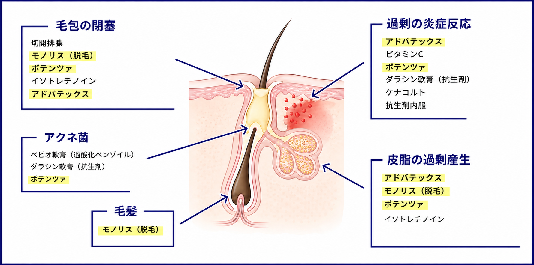 毛包の閉塞、アクネ菌、過剰な炎症反応、皮脂の過剰産生と治療候補を示したイラスト