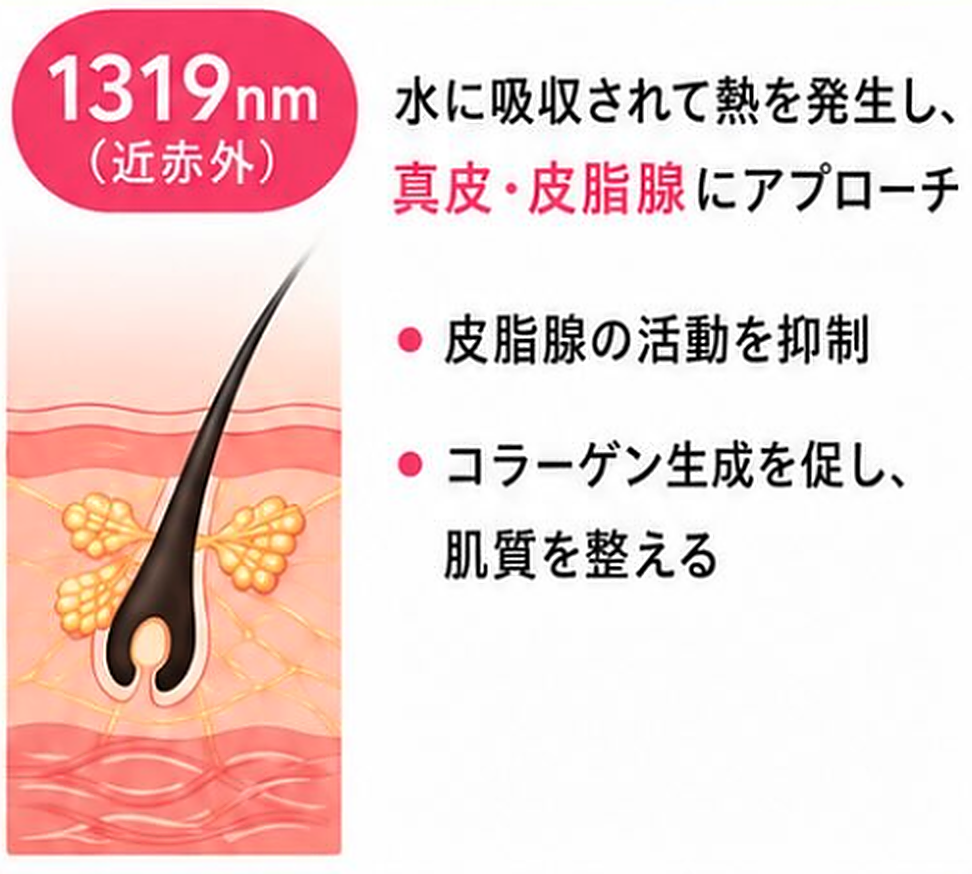 アドバテックスレーザー1319nmは真皮と皮脂腺に熱作用でアプローチする説明図