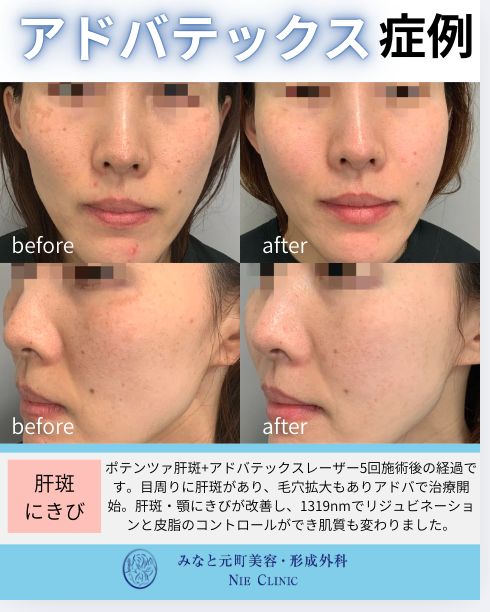 アドバテックスレーザー 肝斑とニキビの症例写真