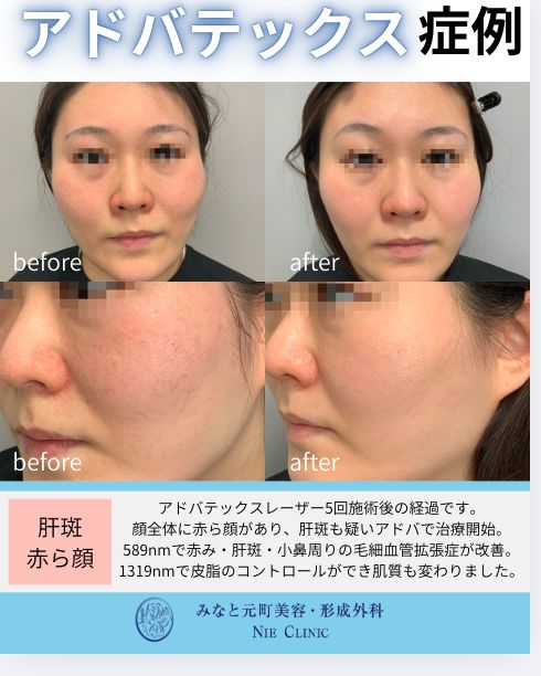 アドバテックスレーザー 肝斑と赤ら顔の症例写真