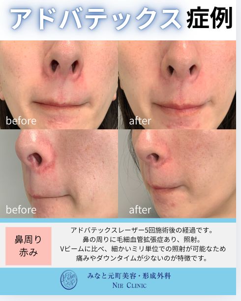 アドバテックスレーザー 鼻周りの赤みの症例写真
