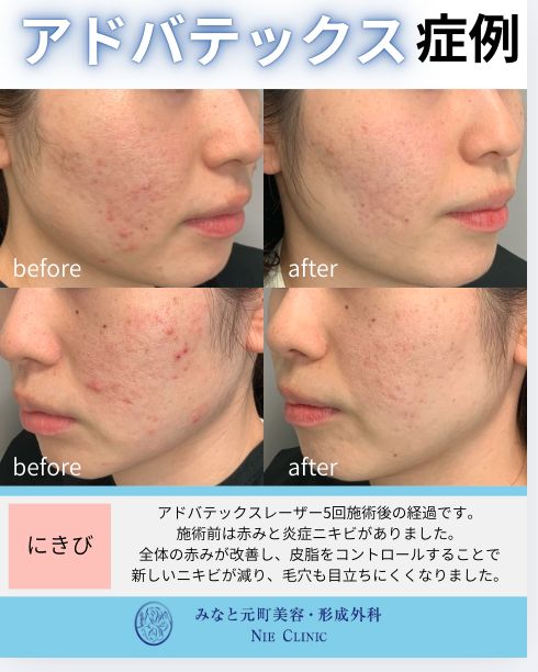 アドバテックスレーザー ニキビと赤みの症例写真