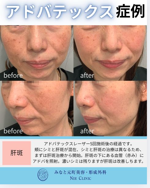 アドバテックスレーザー 肝斑の症例写真