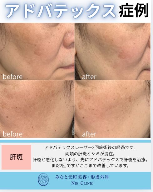 アドバテックスレーザー 肝斑治療の症例写真