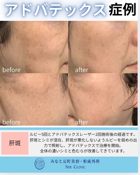 アドバテックスレーザー 肝斑と赤みの症例写真