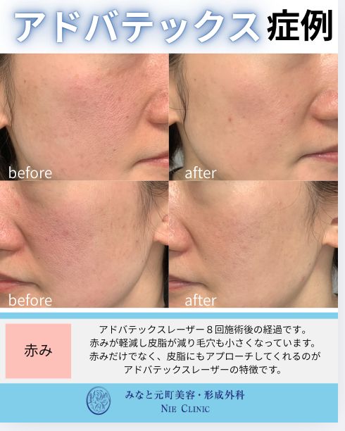 アドバテックスレーザー 赤みの症例写真