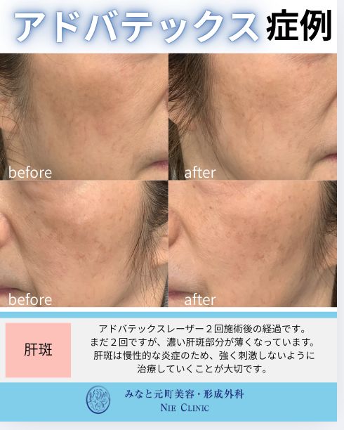 アドバテックスレーザー 肝斑の症例写真 2