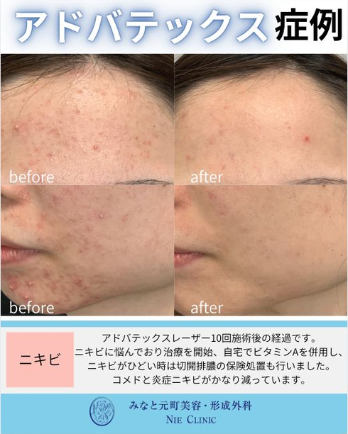 アドバテックスレーザー ニキビの症例写真