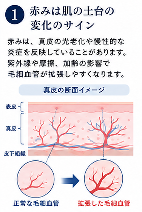 赤みは肌の土台の変化のサインで真皮の光老化や慢性的な炎症を反映する説明図
