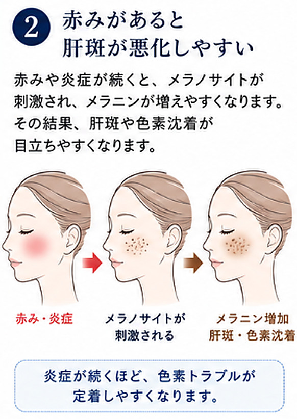 赤みや炎症がメラノサイトを刺激して肝斑や色素沈着が悪化しやすい説明図