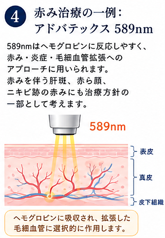 アドバテックスレーザー589nmが赤み炎症毛細血管拡張へアプローチする説明図
