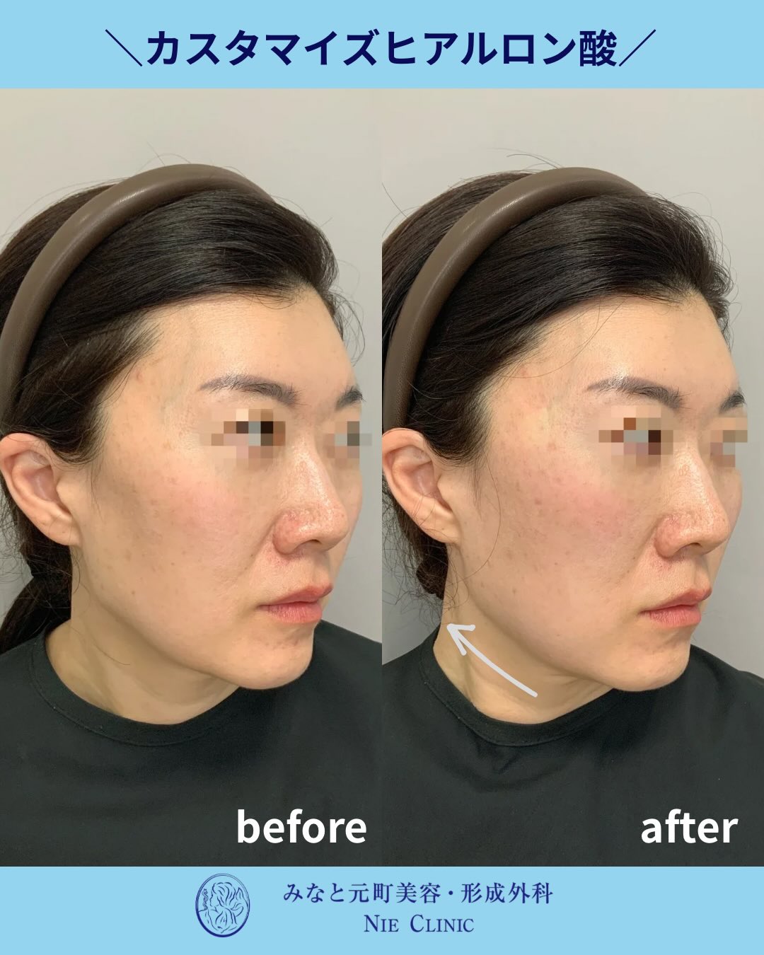 頬こけとフェイスラインへヒアルロン酸4ccを注入した症例写真