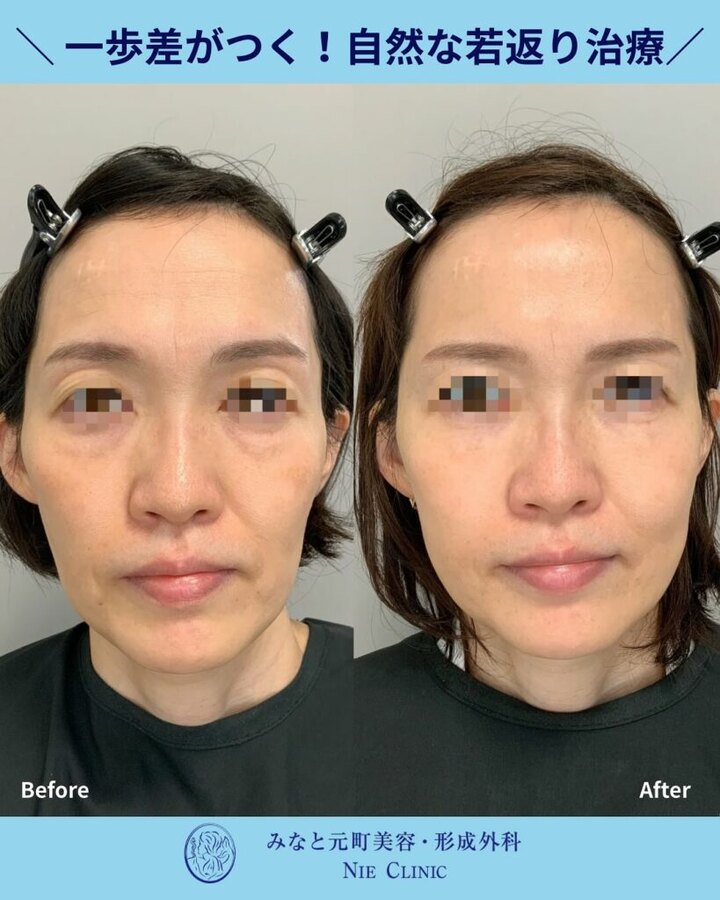 ヒアルロン酸・眼瞼下垂手術・肌治療を重ねた2年間の症例写真
