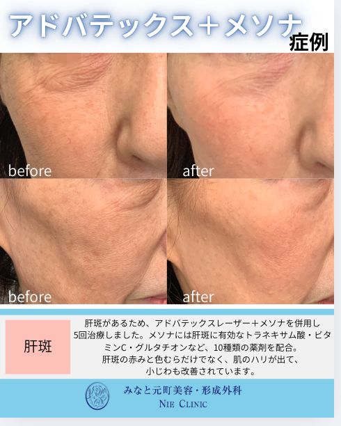 アドバテックスレーザーとメソナJを併用した肝斑・肌育治療の症例写真