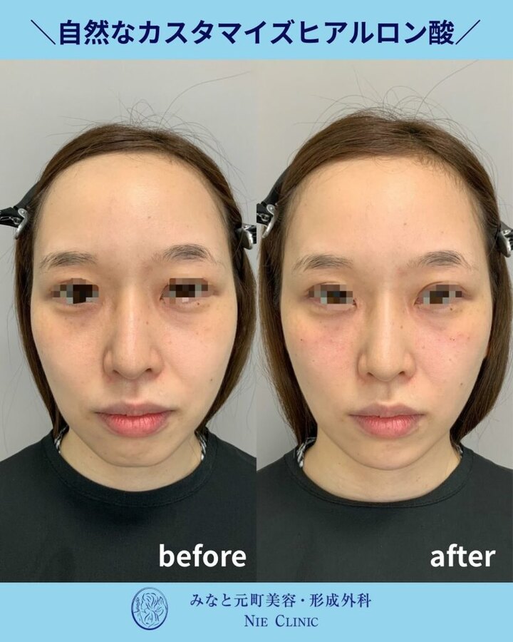 ゴルゴラインへヒアルロン酸を注入したしわ・たるみ治療の症例写真